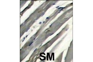 Formalin-fixed and raffin-embedded human hetocarcinoma reacted with RK8 (LRRK2) Antibody  f , which was peroxidase-conjugated to the secondary antibody, followed by DAB staining.