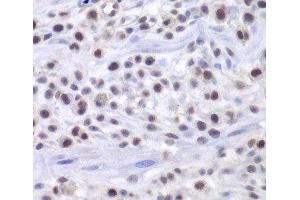 Immunohistochemistry of paraffin-embedded Mouse osteosarcoma using HAT1 Polyclonal Antibody at dilution of 1:200 (40x lens).