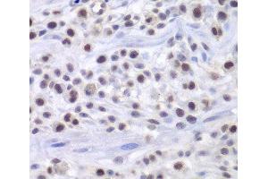 Immunohistochemistry of paraffin-embedded Mouse osteosarcoma using HAT1 Polyclonal Antibody at dilution of 1:200 (40x lens). (HAT1 anticorps)
