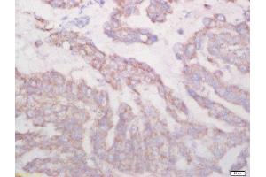 Formalin-fixed and paraffin embedded human lung carcinoma labeled with Rabbit Anti-Biglycan Polyclonal Antibody, Unconjugated (ABIN872817) at 1:200 followed by conjugation to the secondary antibody and DAB staining (Biglycan anticorps  (AA 101-200))
