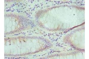 Immunohistochemistry of paraffin-embedded human colon cancer using ABIN7151592 at dilution of 1:100
