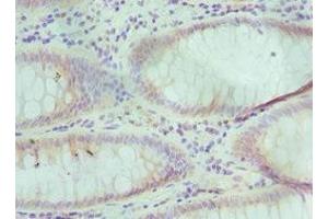 Immunohistochemistry of paraffin-embedded human colon cancer using ABIN7151592 at dilution of 1:100 (TCEB3 anticorps  (AA 679-798))