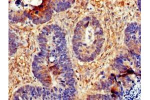 Immunohistochemistry of paraffin-embedded human ovarian cancer using ABIN7147287 at dilution of 1:100