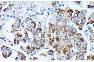 Immunohistochemistry of paraffin-embedded Human liver cancer using PDE3A Polyclonal Antibody at dilution of 1:100 (40x lens). (PDE3A anticorps)