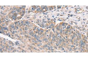 Immunohistochemistry of paraffin-embedded Human ovarian cancer using DECR1 Polyclonal Antibody at dilution of 1:50 (DECR1 anticorps)