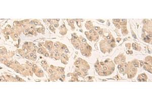 Immunohistochemistry of paraffin-embedded Human gastric cancer tissue using FABP4 Polyclonal Antibody at dilution of 1:60(x200)