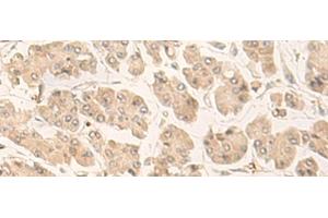 Immunohistochemistry of paraffin-embedded Human gastric cancer tissue using FABP4 Polyclonal Antibody at dilution of 1:60(x200) (FABP4 anticorps)