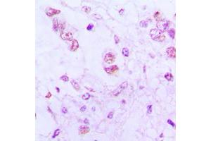 Immunohistochemical analysis of ATF3 staining in human lung cancer formalin fixed paraffin embedded tissue section. (ATF3 anticorps  (C-Term))