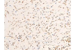 ABIN6267072 at 1/100 staining human muscle tumor tissue sections by IHC-P.