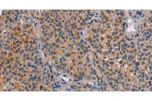 Immunohistochemistry of paraffin-embedded Human liver cancer tissue using MAP3K13 Polyclonal Antibody at dilution 1:40 (MAP3K13 anticorps)