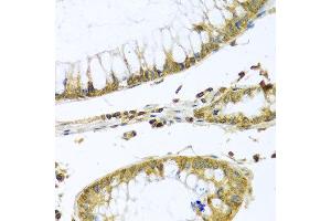 Immunohistochemistry of paraffin-embedded human colon carcinoma using PMPCB antibody at dilution of 1:100 (x40 lens). (PMPCB anticorps)
