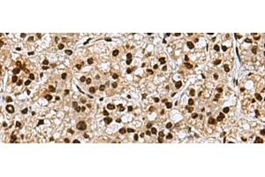 Immunohistochemistry of paraffin-embedded Human liver cancer tissue using MYEF2 Polyclonal Antibody at dilution of 1:70(x200)