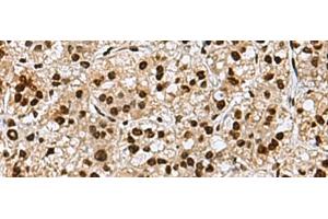 Immunohistochemistry of paraffin-embedded Human liver cancer tissue using MYEF2 Polyclonal Antibody at dilution of 1:70(x200) (MYEF2 anticorps)