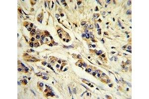 IHC analysis of FFPE human breast carcinoma stained with IL-10 antibody (IL-10 anticorps  (AA 27-53))