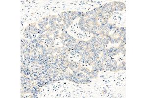 IHC analysis of HE4/WFDC2 using anti-HE4/WFDC2 antibody (ABIN5693137). (WFDC2 anticorps  (AA 31-124))