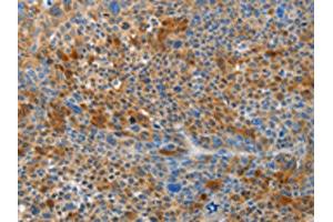 The image on the left is immunohistochemistry of paraffin-embedded Human liver cancer tissue using ABIN7191027(HTRA3 Antibody) at dilution 1/45, on the right is treated with synthetic peptide. (HTRA3 anticorps)