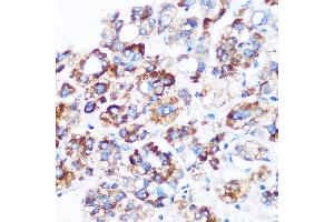 Immunohistochemistry of paraffin-embedded Human liver cancer using C9orf114 Rabbit pAb (ABIN7266390) at dilution of 1:100 (40x lens). (C9orf114 anticorps)