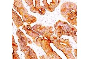 IHC testing of FFPE human colon carcinoma and Multi Cytokeratin antibody (clone C11).