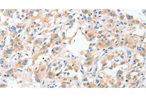 Immunohistochemistry of paraffin-embedded Human thyroid cancer using RPN1 Polyclonal Antibody at dilution of 1:30 (RPN1 anticorps)