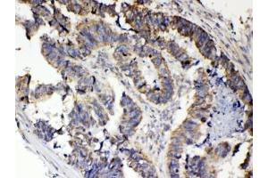 IHC testing of FFPE human intestinal cancer tissue with RANK antibody at 1ug/ml. (TNFRSF11A anticorps  (AA 235-262))