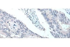 Immunohistochemistry of paraffin-embedded Human colorectal cancer tissue using VPS35 Polyclonal Antibody at dilution of 1:25(x200)