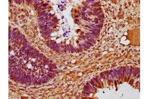 IHC image of ABIN7153389 diluted at 1:225 and staining in paraffin-embedded human ovarian cancer performed on a Leica BondTM system.