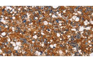 Immunohistochemistry of paraffin-embedded Human thyroid cancer tissue using COX5A Polyclonal Antibody at dilution 1:40