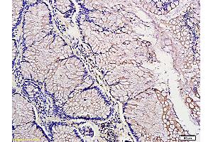 Formalin-fixed and paraffin embedded: human colon tubular adenocarcinoma labeled with Anti-PDGF-A Polyclonal Antibody (ABIN726155), Unconjugated at 1:300, followed by conjugation to the secondary antibody and DAB staining (PDGFA anticorps  (AA 125-170))