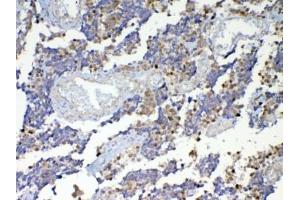 IHC testing of FFPE human lung cancer tissue with Dnmt1 antibody at 1ug/ml. (DNMT1 anticorps)