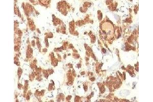Formalin-fixed, paraffin-embedded human thyroid carcinoma stained with Cytokeratin 18 antibody. (Cytokeratin 18 anticorps)