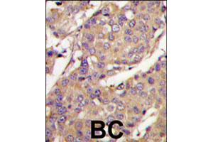 Formalin-fixed and paraffin-embedded human breast carcinoma tissue reacted with UBE2L6 polyclonal antibody  , which was peroxidase-conjugated to the secondary antibody, followed by DAB staining. (UBE2L6 anticorps  (C-Term))