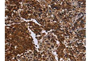 The image on the left is immunohistochemistry of paraffin-embedded Human liver cancer tissue using ABIN7190664(FMN2 Antibody) at dilution 1/30, on the right is treated with synthetic peptide. (Formin 2 anticorps)