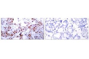 Immunohistochemical analysis of paraffin-embedded human breast carcinoma tissue using ATF-2 (Ab-62 or 44) antibody (E021029). (ATF2 anticorps)