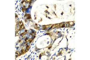 Immunohistochemistry of paraffin-embedded human gastric cancer using SNCA antibody at dilution of 1:100 (x40 lens). (SNCA anticorps)