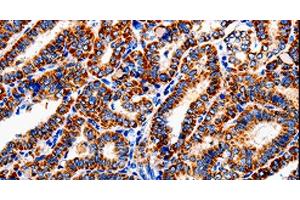 Immunohistochemistry of paraffin-embedded Human thyroid cancer tissue using COX19 Polyclonal Antibody at dilution 1:50