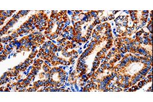 Immunohistochemistry of paraffin-embedded Human thyroid cancer tissue using COX19 Polyclonal Antibody at dilution 1:50 (COX19 anticorps)