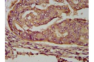 IHC image of ABIN7159857 diluted at 1:200 and staining in paraffin-embedded human endometrial cancer performed on a Leica BondTM system.