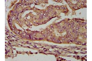 IHC image of ABIN7159857 diluted at 1:200 and staining in paraffin-embedded human endometrial cancer performed on a Leica BondTM system. (ENOSF1 anticorps  (AA 171-286))