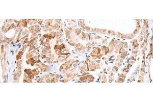 Immunohistochemistry of paraffin-embedded Human thyroid cancer tissue using HOXC11 Polyclonal Antibody at dilution of 1:25(x200) (HOXC11 anticorps)