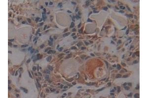 Detection of PKCi in Human Lung cancer Tissue using Polyclonal Antibody to Protein Kinase C Iota (PKCi)