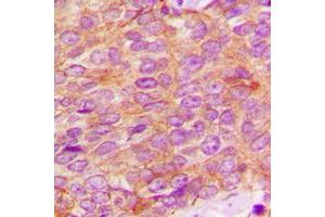 Immunohistochemical analysis of Kallikrein 3 staining in human breast cancer formalin fixed paraffin embedded tissue section.