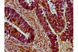 IHC image of ABIN7168962 diluted at 1:500 and staining in paraffin-embedded human ovarian cancer performed on a Leica BondTM system.