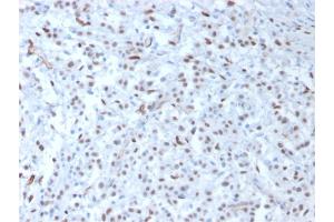 Formalin-fixed, paraffin-embedded human Mesothelioma stained with Wilm's Tumor Mouse Monoclonal Antibody (WT1/857).