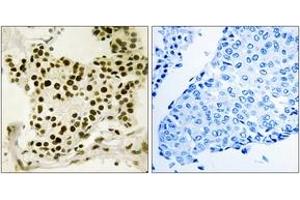 Immunohistochemistry analysis of paraffin-embedded human breast carcinoma, using UBF (Phospho-Ser484) Antibody. (UBTF anticorps  (pSer484))
