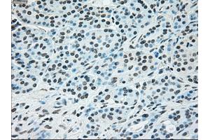 Immunohistochemical staining of paraffin-embedded Ovary tissue using anti-BRAFmouse monoclonal antibody. (BRAF anticorps)
