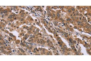 Immunohistochemistry of paraffin-embedded Human liver cancer tissue using FAM3B Polyclonal Antibody at dilution 1:40 (FAM3B anticorps)