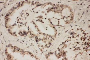 Anti-FGFR1 antibody, IHC(P) IHC(P): Human Lung Cancer Tissue