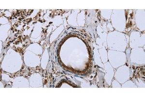 Immunohistochemistry of paraffin-embedded Human breast cancer using FBP1 Polyclonal Antibody at dilution of 1:40 (FBP1 anticorps)