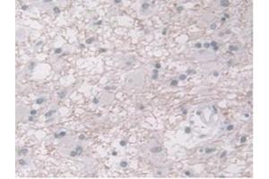 DAB staining on IHC-P;Samples:Human Glioma Tissue) (ORM1 anticorps  (AA 19-201))