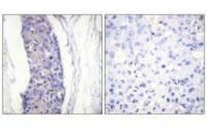Immunohistochemistry analysis of paraffin-embedded human breast carcinoma tissue using Tubulin α antibody.